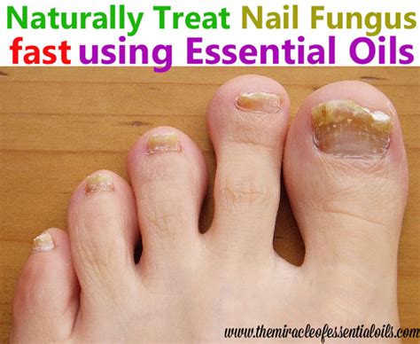 How To Treat Toenail Fungus With Essential Oils The Miracle Of