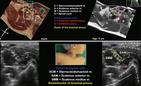 Ultrasound Guided Interscalene Brachial Plexus Block Anesthesia Key