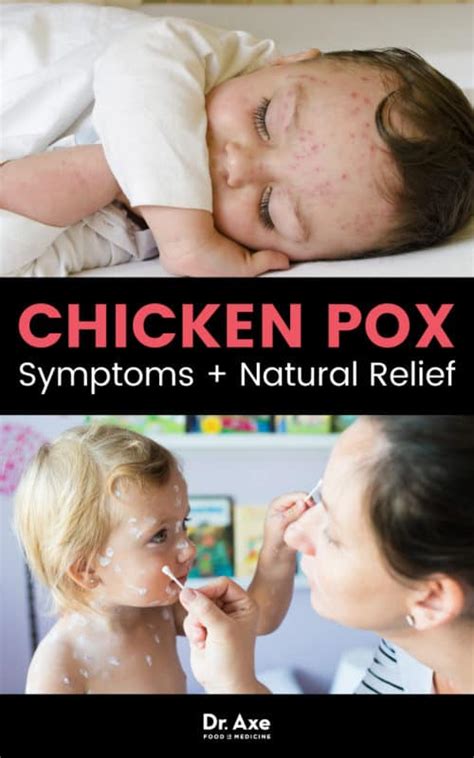 Chicken Pox Symptoms How To Find Natural Relief Dr Axe