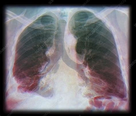 Kaposis Sarcoma Of The Lung Ct Scan Stock Image C0132191