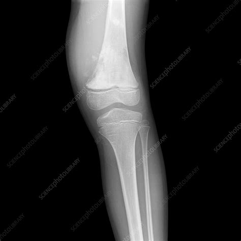 Bone Cancer Of The Leg X Ray Stock Image C0386692 Science Photo
