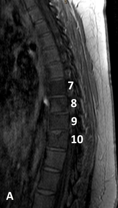 Lymphoma Hodgkin Spine Mri Online