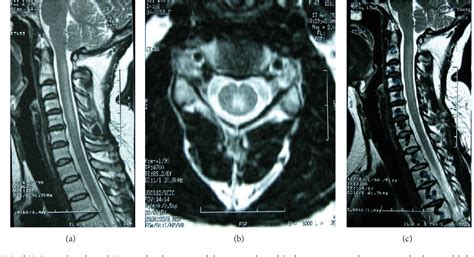 Figure 1 From Subacute Combined Degeneration Of The Spinal Cord Due To