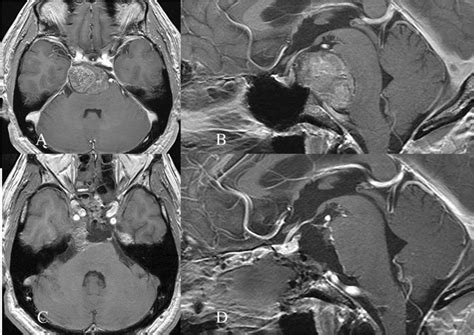 Head Mr Imaging With Contrast Medium Showing Massive Clival Tumor