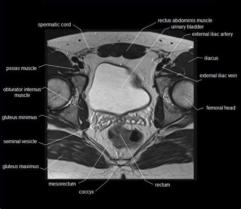Pelvis Muscles Mri Anatomy Mri Female Pelvis Anatomy Axial Image 1