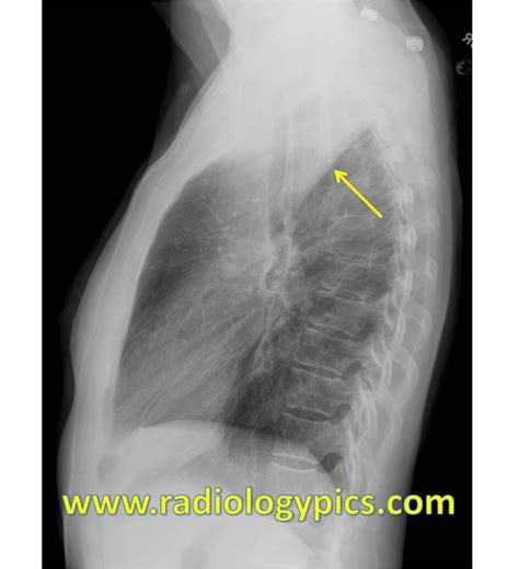 The Golden S Sign Right Upper Lobe Collapse Radiologypicscom
