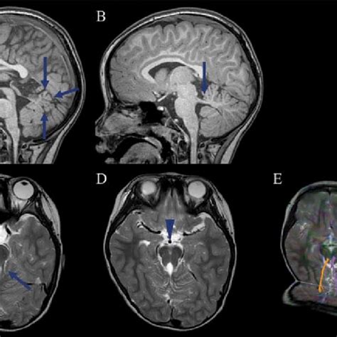 Magnetic Resonance Imaging Findings In A Patient With Joubert Syndrome