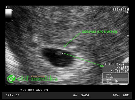 Foto ibu hamil kembar 5. Hasil Usg Kehamilan 7 Minggu