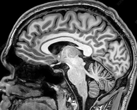 Normal Sagittal Brain Mri Hot Sex Picture