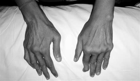 Parkinsonism Mimicking Rheumatoid Arthritis The Journal Of Rheumatology