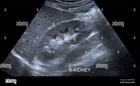 Healthy Kidney Ultrasound Scan Stock Photo Alamy