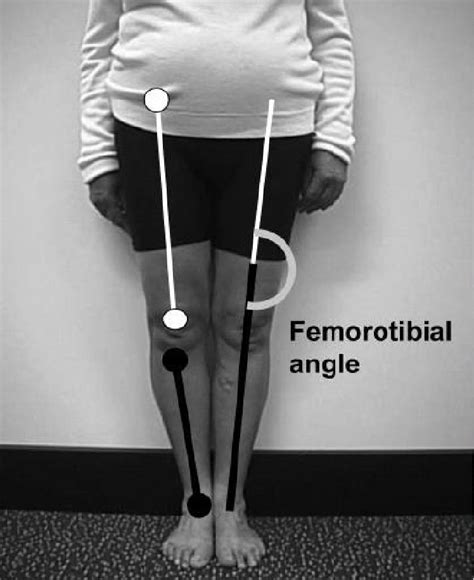 A Graphical Representation Of The Femorotibial Angle Download