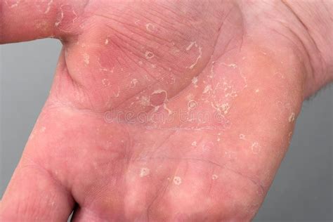 Dry Man S Hand With Skin Peeling Off Eczema Dermatitis Stock Photo