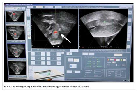 Clinical Applications Of High Intensity Focused Ultrasound Hkmj