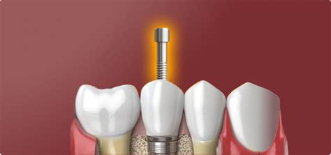 Dental Implant Screws Preat Corporation