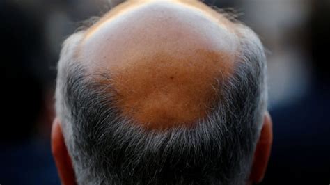 Cure For Baldness Science Discovery Bjaysam
