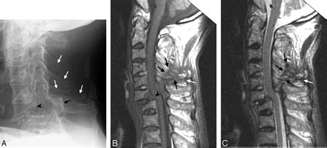 Imaging Manifestations Of Spinal Fractures In Ankylosing Spondylitis