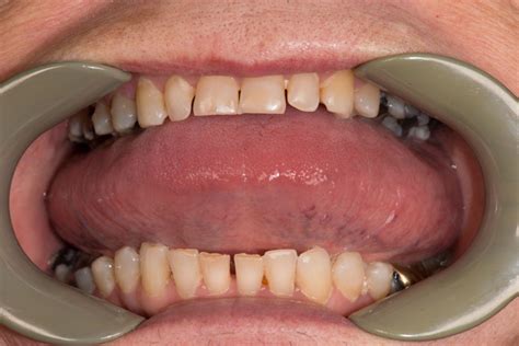 surgical management of macroglossia secondary to amyloidosis bmj case reports
