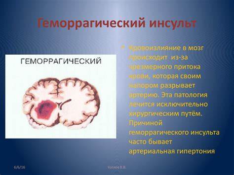 Геморрагический инсульт диета Инсульт. Виды инсульта - online presentation Инсульт. Виды инсульта - online presentation Геморрагический инсульт диета