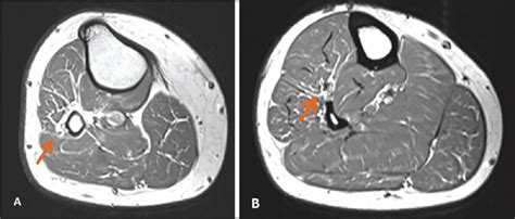 Isolated Deep Peroneal Nerve Palsy Role Of Magnetic Resonance Imaging