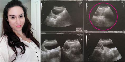 What Its Really Like To Be Born Without A Vagina Womb And Cervix