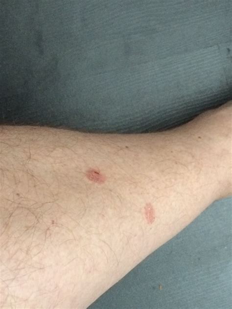 Round Red Spots On Legs Pictures Photos Vrogue Co