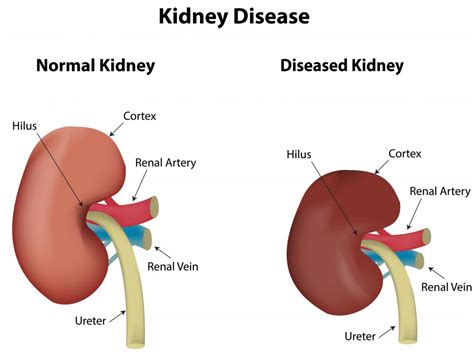 What Are The Causes Of Kidney Lesions With Pictures