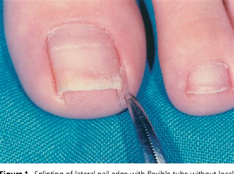 Nail‐splinting Technique For Ingrown Nails The Therapeutic Effects And