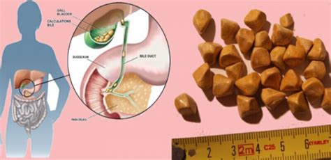 Gallstones Symptom Causes Type Risk Factors And Complications