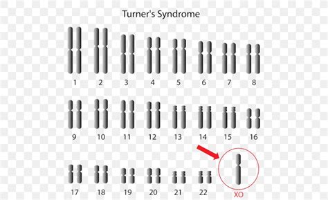 Monosomy Turner Syndrome X Chromosome Triple X Syndrome PNG 500x500px