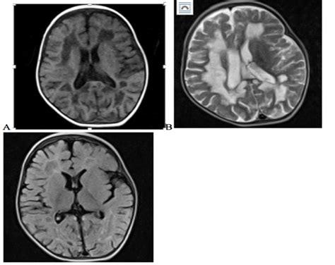 Pre Contrast Axial T1 Weighted Magnetic Resonance Imaging A Showing