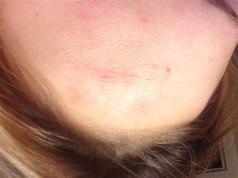 Rough Texture Dry Patches On Cheeks Large Pores Hormonal Acne Acne