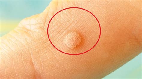 How To Get Rid Of Finger Warts At Home Youtube