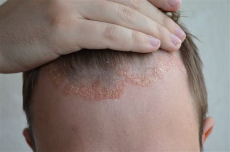 Dermatite Seborroica Come Si Cura Con I Rimedi Naturali