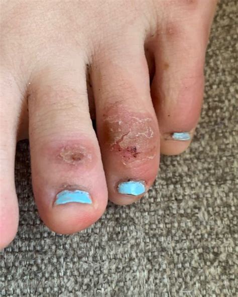 It's unclear how common covid toes are — because it's unclear what percentage of the u.s. 'COVID toes' might be the latest unusual sign that people are infected with the novel ...