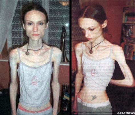 Anorexic Woman Dropped To Three Stone After Walking Hours A Day Daily Mail Online