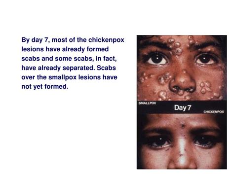 Ppt Diagnosis Of Smallpox Powerpoint Presentation Free Download Id
