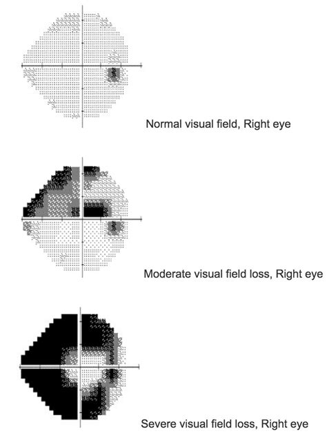 Glaucoma Exame Campo Visual Astigmatism Glaucoma Swollen Eyes Disease