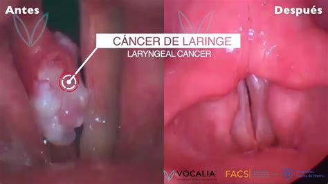 Aprender Sobre Imagem Cancer De Garganta Fotos Br Thptnganamst Edu Vn
