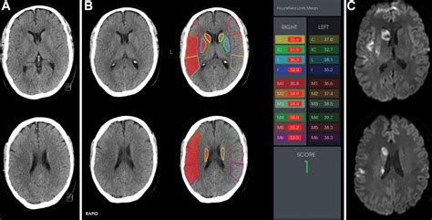 Automated Calculation Of The Alberta Stroke Program Early Ct Score