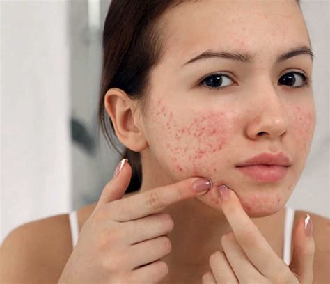 Can Dandruff Cause Acne On The Face Healthy Anozo