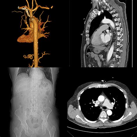 Computed tomography (ct) of organs, bones and blood vessels allow froedtert & mcw radiologists to diagnose problems such as cancer or cardiovascular disease. Computed Tomography (CT Scan) | The Imaging Center | MRI ...