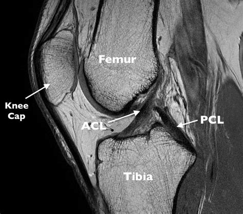 Basic Mri Evaluation Of An Acl Tear