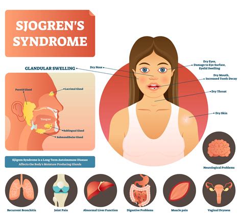 Sjögrens Syndrome