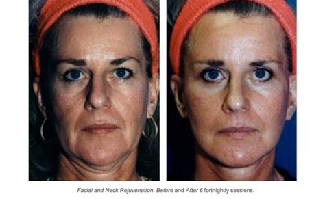 Fractional face mesotherapy is considered a less traumatic treatment, so you can go about your business right after the procedure. Before and After | SF Medica