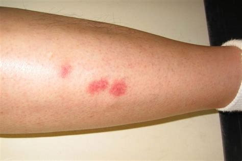 Bug Bite Symptoms You Should Never Ignore The Healthy