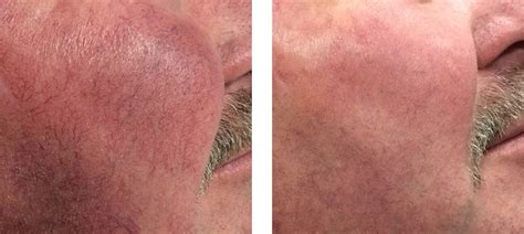 Broken Capillaries Treatment Melbourne Collins Cosmetic Clinic