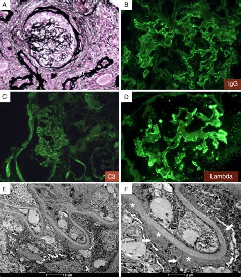 Membranous Glomerulonephritis Secondary To Syphilis A Glomerulus