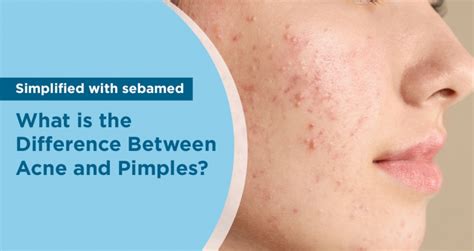 What Is The Difference Between Acne And Pimples