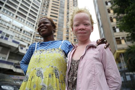Malawi Albinos Hunted And Killed For Body Parts Immortal News